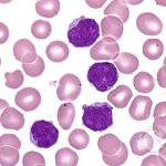 Leucemia promielotica
