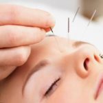 Agopuntura-e-medicina-estetica