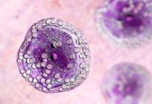 Linfoma diffuso a grandi cellule B